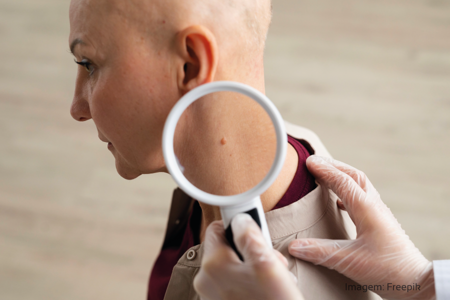 5 dicas para identificar o câncer de pele